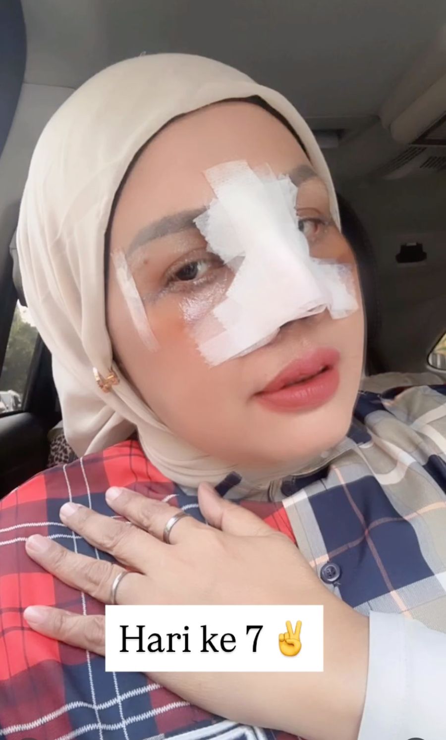 Potret Terbaru Elly Sugigi Setelah Oplas, Kini Berhidung Mancung